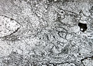F,25y. | giant multinuclear osteoclast - aneurysmatic cyst - tibia F,25y. | giant multinuclear osteoclast - aneurysmatic cyst - tibia